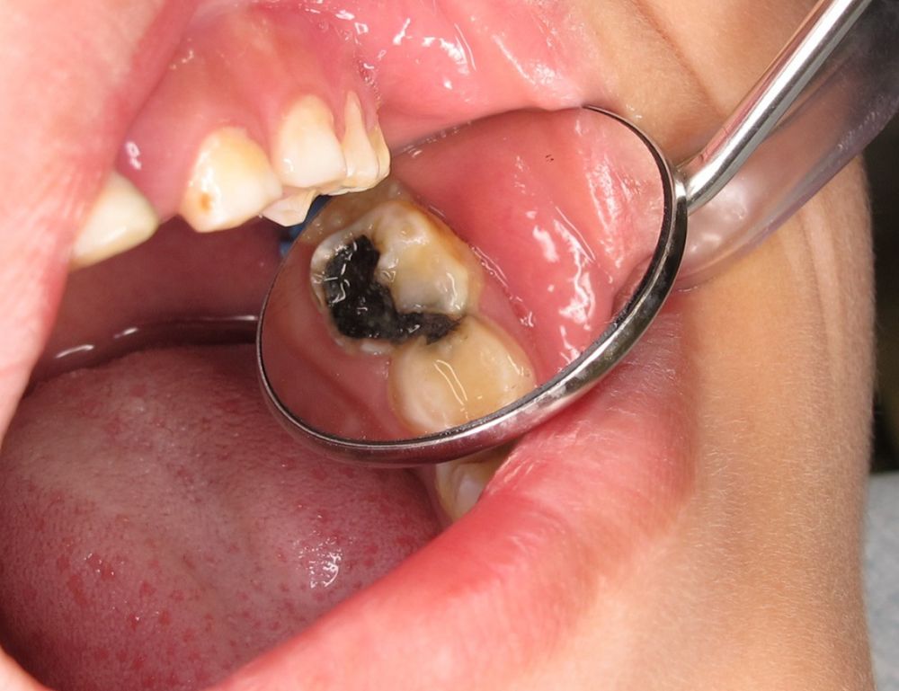 Лечение кариеса